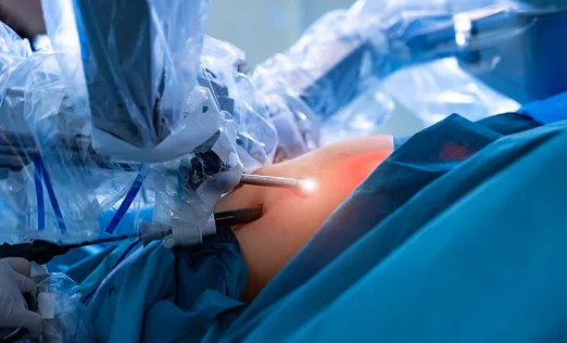 Laparoscopic for Endometriosis